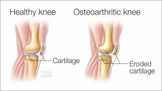 Arthritis Pain Inflammation 2
