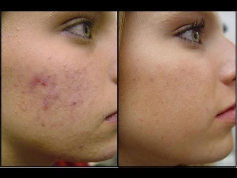 Hormonal Acne 1