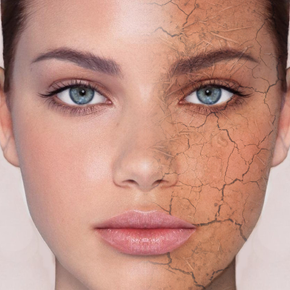 Winter And Dry Skin 1
