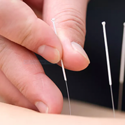 Acupuncture