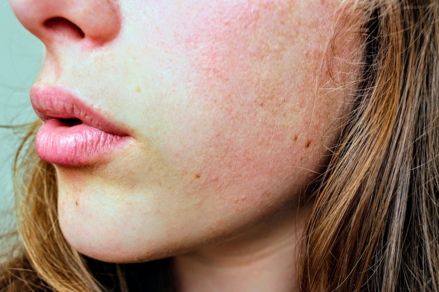 Winter and Dry Skin